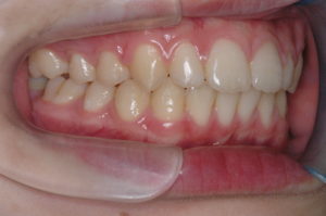つくば・土浦の矯正歯科　つるみ矯正歯科　歯並び矯正症例D　上顎前突（出っ歯）